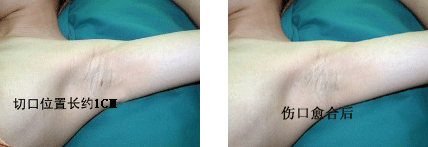 韩国Nm汗腺定位消融术手术前后对比 改良小切口汗腺清除术前后对比.GIF