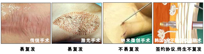 腋臭好的治疗方法 手术效果对比.jpg