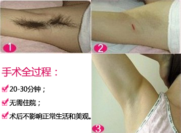 腋臭治疗手术效果图 quanguocheng.jpg